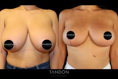 Mommy Makeover Before & After Gallery - Patient 210069 - Image 1