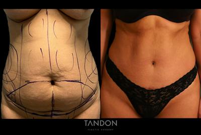Liposuction and Fat Transfer Before & After Gallery - Patient 409894 - Image 1
