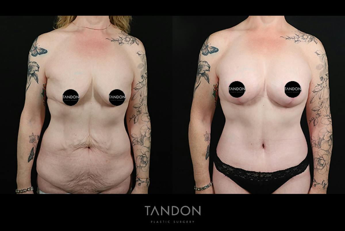 Breast Lift with Implants Before & After Gallery - Patient 265677 - Image 1