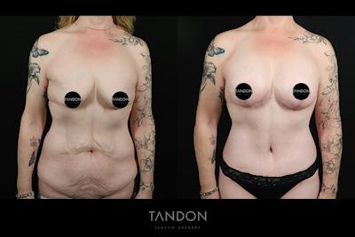Breast Lift with Implants Before & After Gallery - Patient 265677 - Image 1