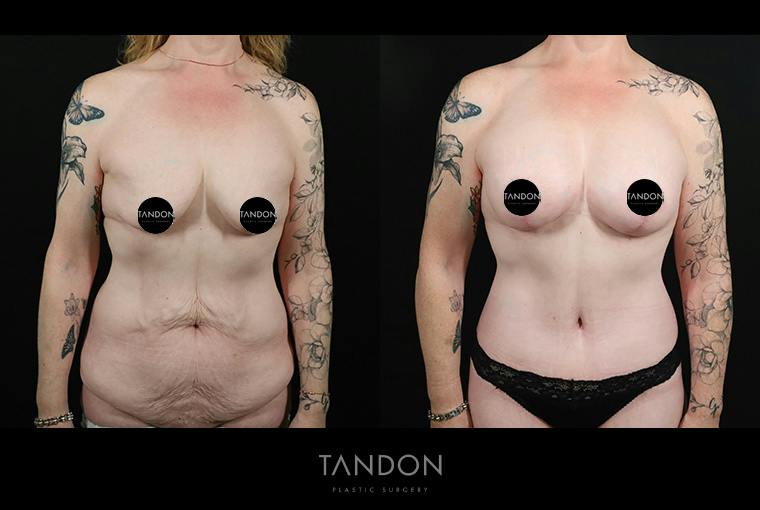 Breast Lift with Implants Before & After Gallery - Patient 265677 - Image 1