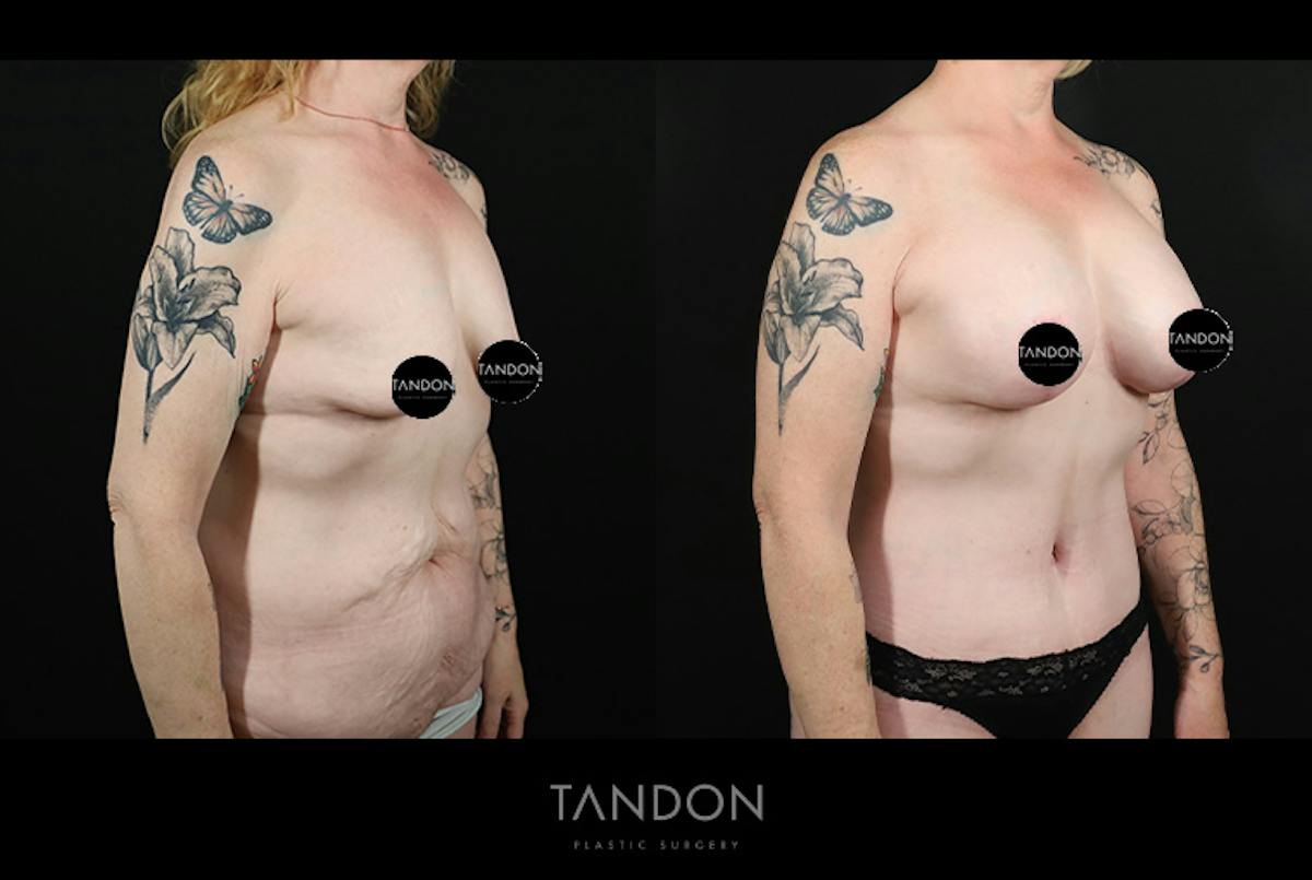 Breast Lift with Implants Before & After Gallery - Patient 265677 - Image 2