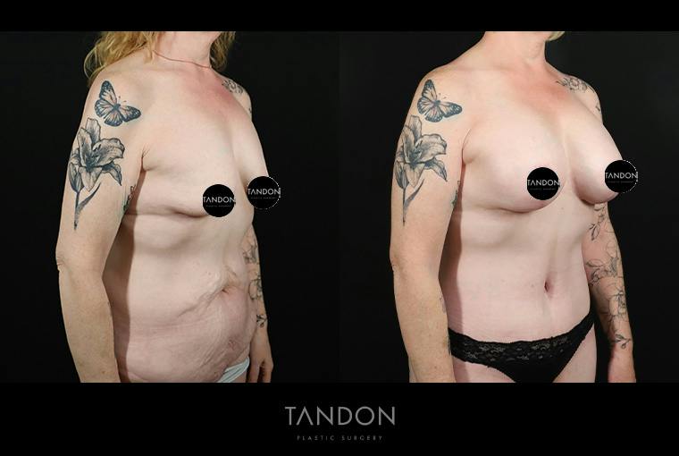 Breast Lift with Implants Before & After Gallery - Patient 265677 - Image 2