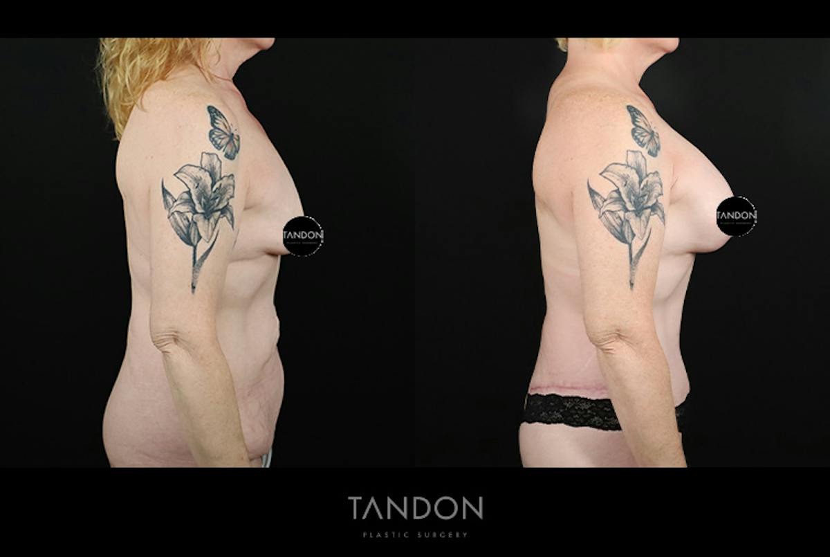 Breast Lift with Implants Before & After Gallery - Patient 265677 - Image 3