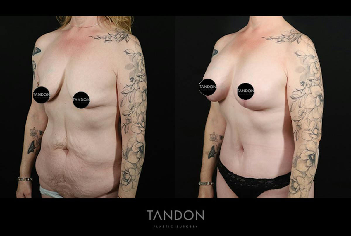 Breast Lift with Implants Before & After Gallery - Patient 265677 - Image 4