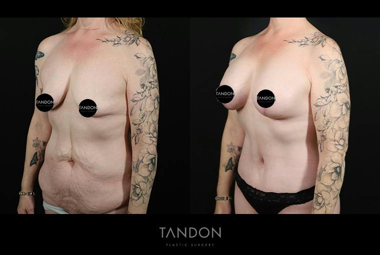 Breast Lift with Implants Before & After Gallery - Patient 265677 - Image 4