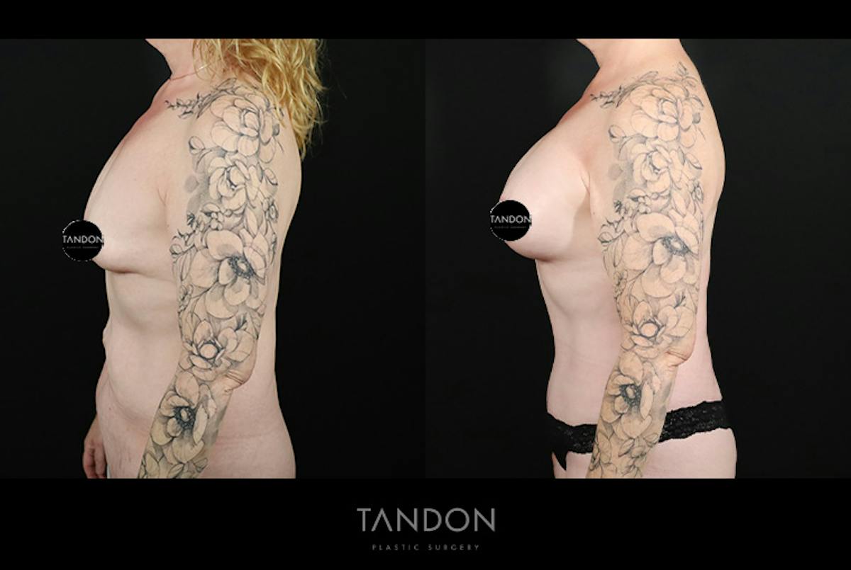 Breast Lift with Implants Before & After Gallery - Patient 265677 - Image 5