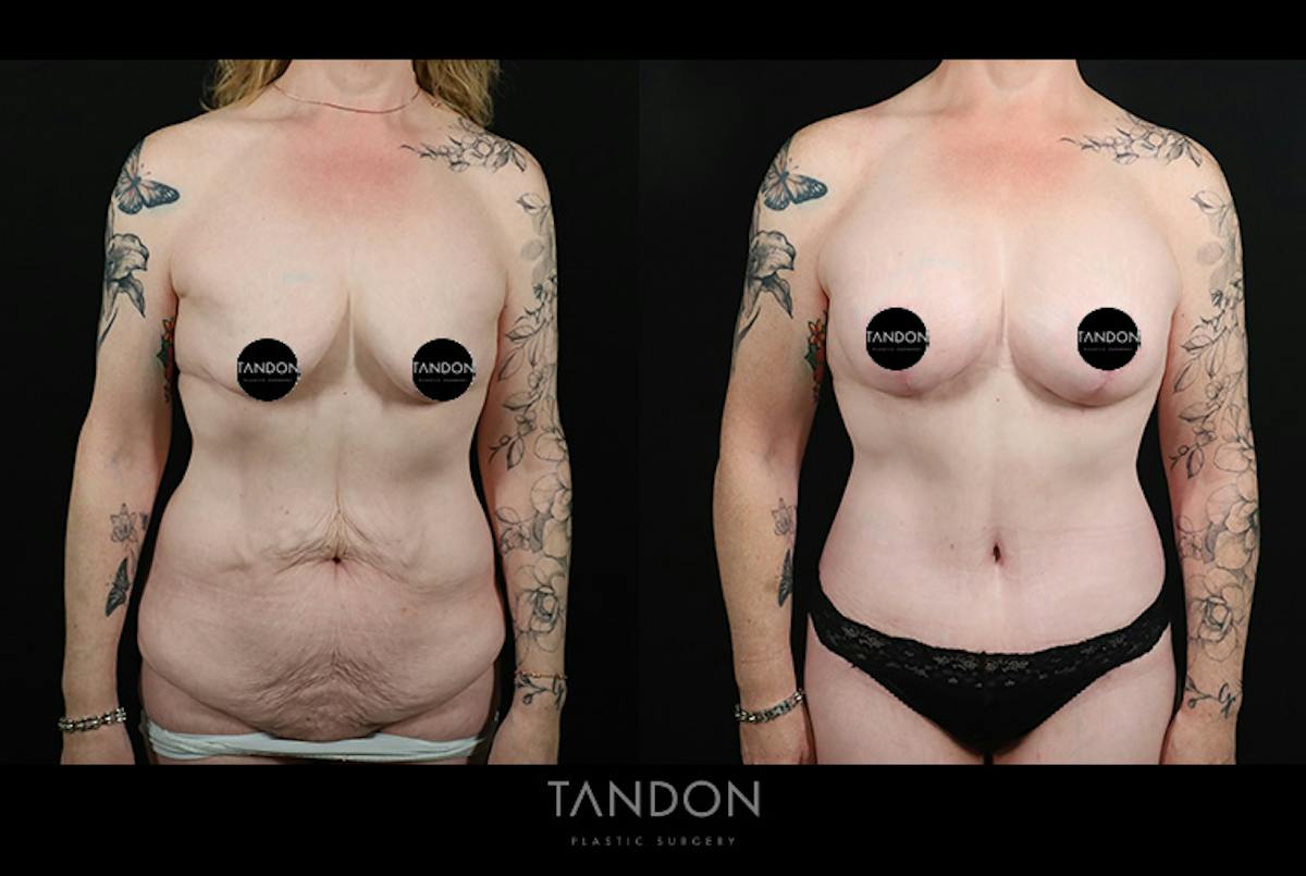 Abdominoplasty (Tummy Tuck) Before & After Gallery - Patient 291563 - Image 1