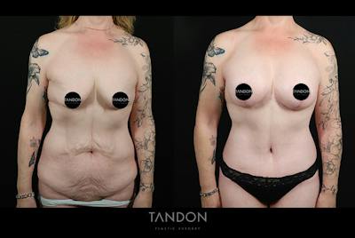 Abdominoplasty (Tummy Tuck) Before & After Gallery - Patient 291563 - Image 1