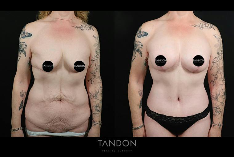 Abdominoplasty (Tummy Tuck) Before & After Gallery - Patient 291563 - Image 1