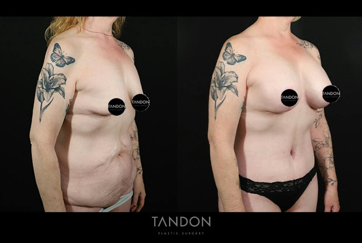 Abdominoplasty (Tummy Tuck) Before & After Gallery - Patient 291563 - Image 2