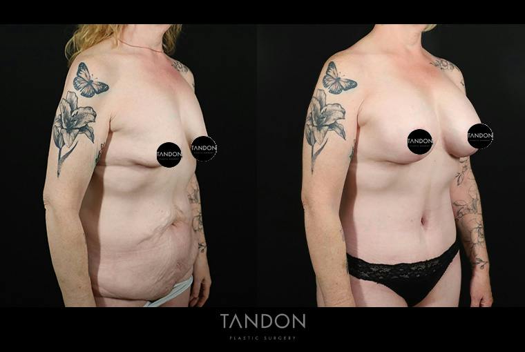 Abdominoplasty (Tummy Tuck) Before & After Gallery - Patient 291563 - Image 2
