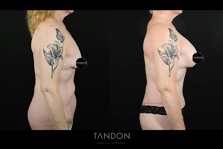 Abdominoplasty (Tummy Tuck) Before & After Gallery - Patient 291563 - Image 3