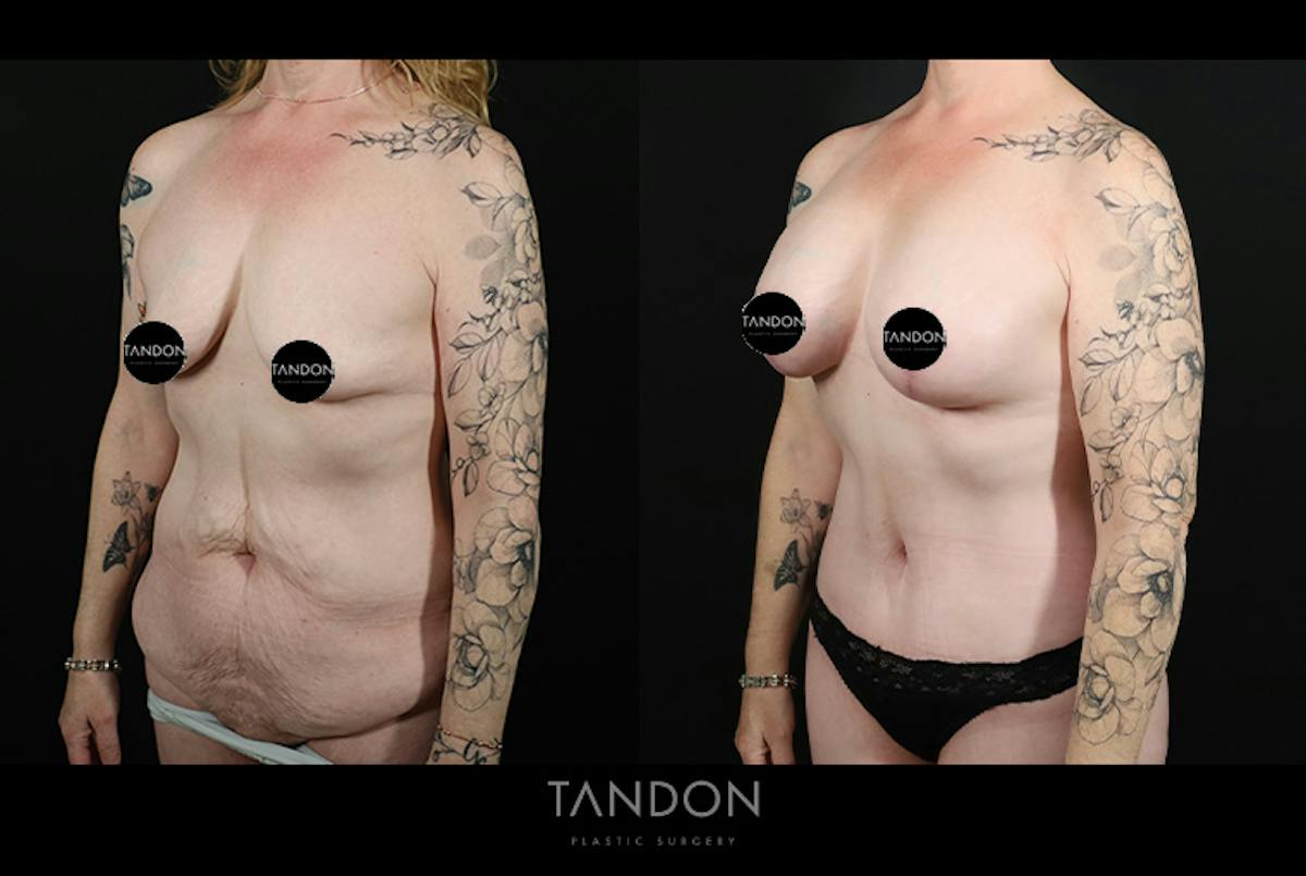 Abdominoplasty (Tummy Tuck) Before & After Gallery - Patient 291563 - Image 4