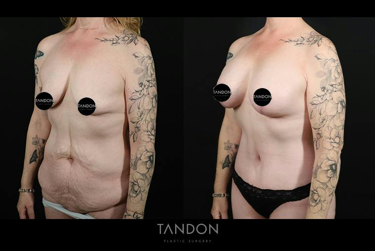 Abdominoplasty (Tummy Tuck) Before & After Gallery - Patient 291563 - Image 4