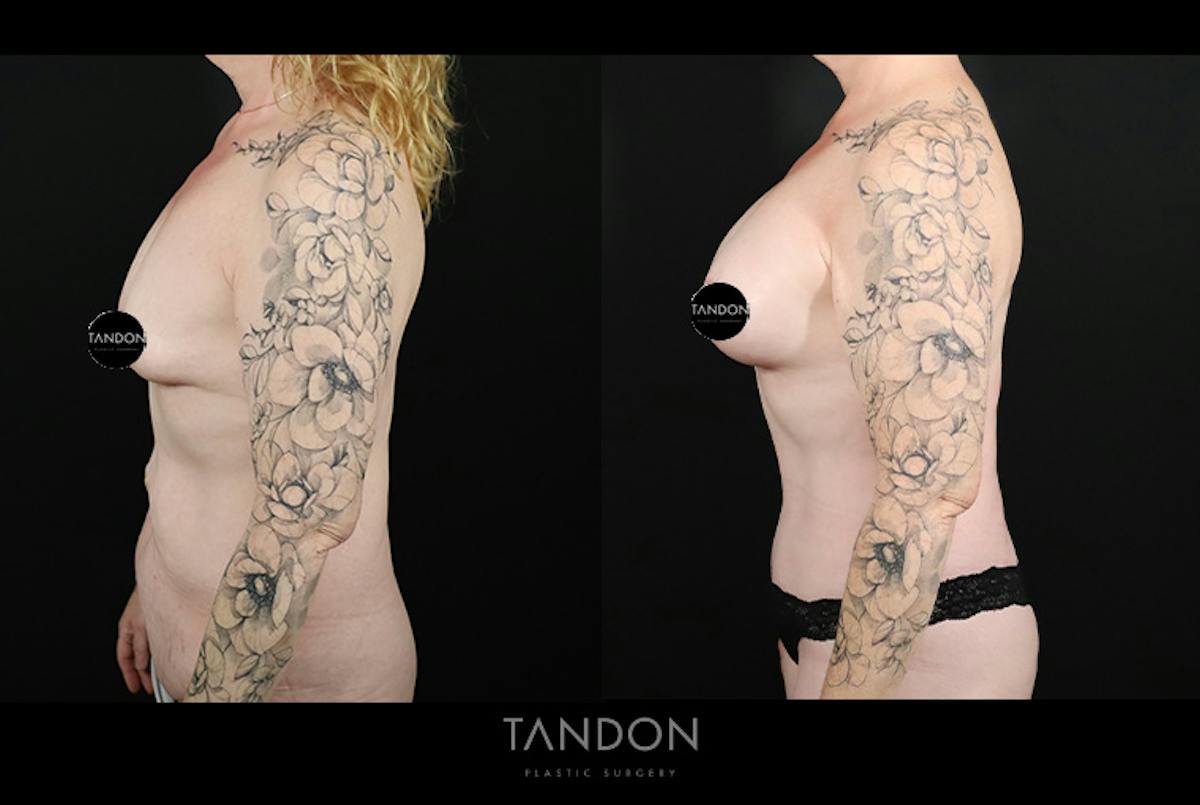 Abdominoplasty (Tummy Tuck) Before & After Gallery - Patient 291563 - Image 5