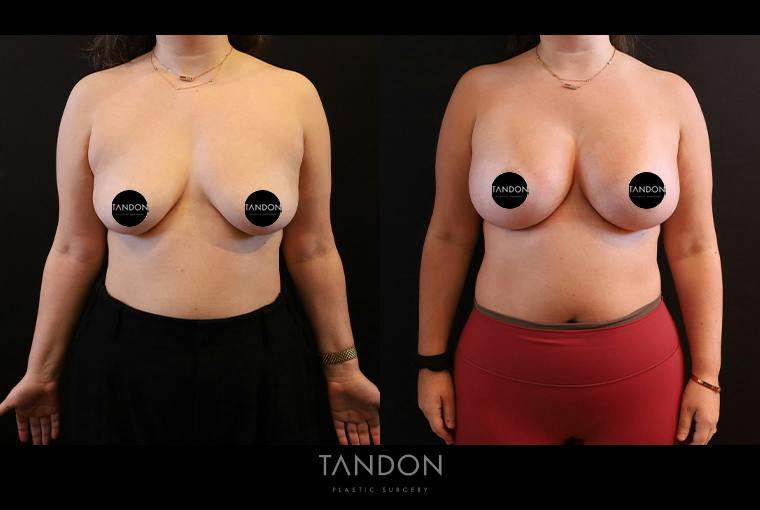 Breast Augmentation Before & After Gallery - Patient 500437 - Image 1