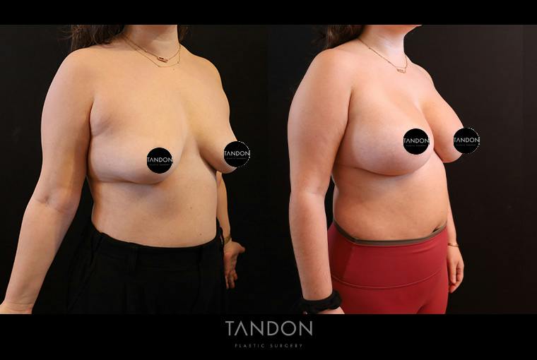 Breast Augmentation Before & After Gallery - Patient 500437 - Image 2