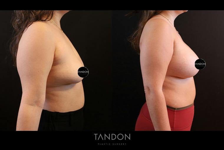 Breast Augmentation Before & After Gallery - Patient 500437 - Image 3