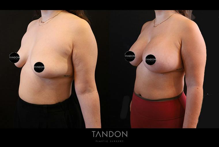 Breast Augmentation Before & After Gallery - Patient 500437 - Image 4