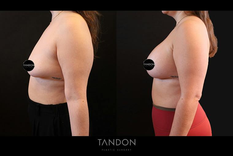 Breast Augmentation Before & After Gallery - Patient 500437 - Image 5