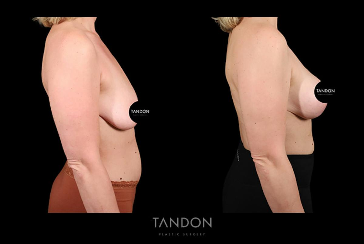 Preservé by Motiva Breast Augmentation Before & After Gallery - Patient 389604 - Image 2