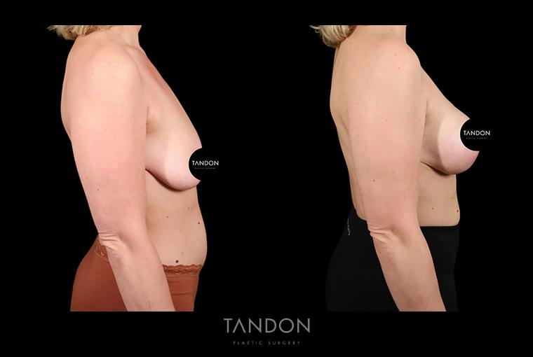 Preservé by Motiva Breast Augmentation Before & After Gallery - Patient 389604 - Image 2