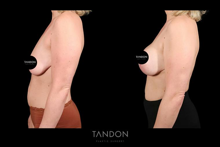 Preservé by Motiva Breast Augmentation Before & After Gallery - Patient 389604 - Image 4