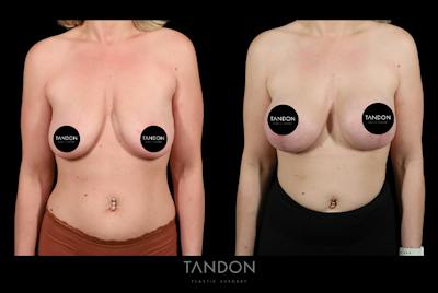 Preservé by Motiva Breast Augmentation Before & After Gallery - Patient 389604 - Image 1