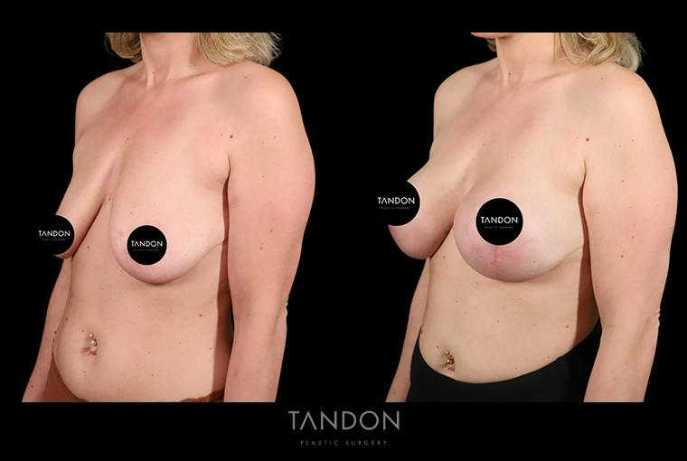 Preservé by Motiva Breast Augmentation Before & After Gallery - Patient 389604 - Image 3