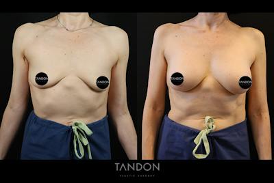 Preservé by Motiva Breast Augmentation Before & After Gallery - Patient 254028 - Image 1