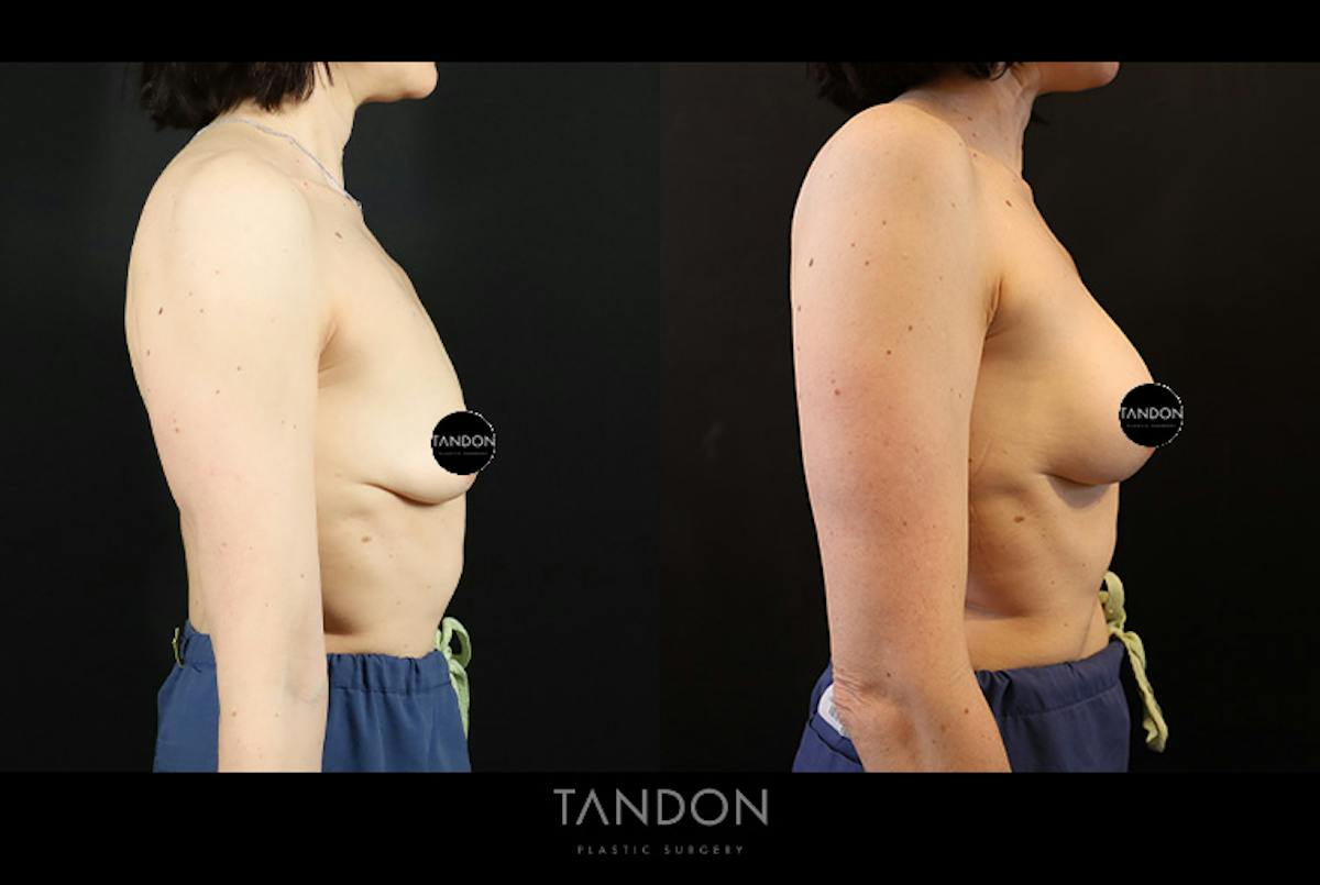 Preservé by Motiva Breast Augmentation Before & After Gallery - Patient 254028 - Image 2