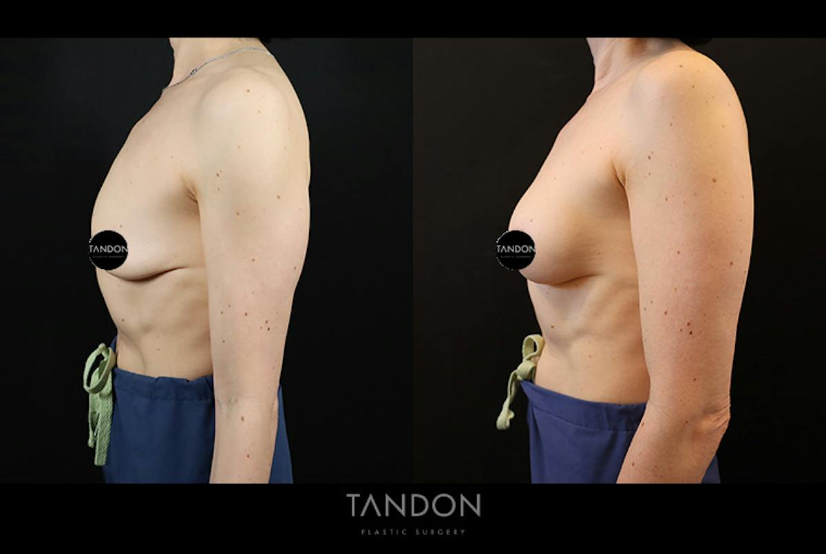 Preservé by Motiva Breast Augmentation Before & After Gallery - Patient 254028 - Image 3