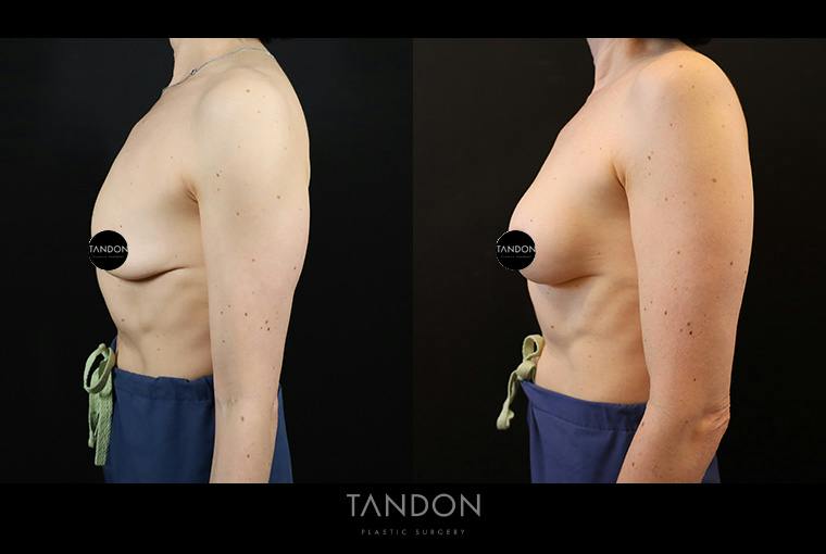 Preservé by Motiva Breast Augmentation Before & After Gallery - Patient 254028 - Image 3