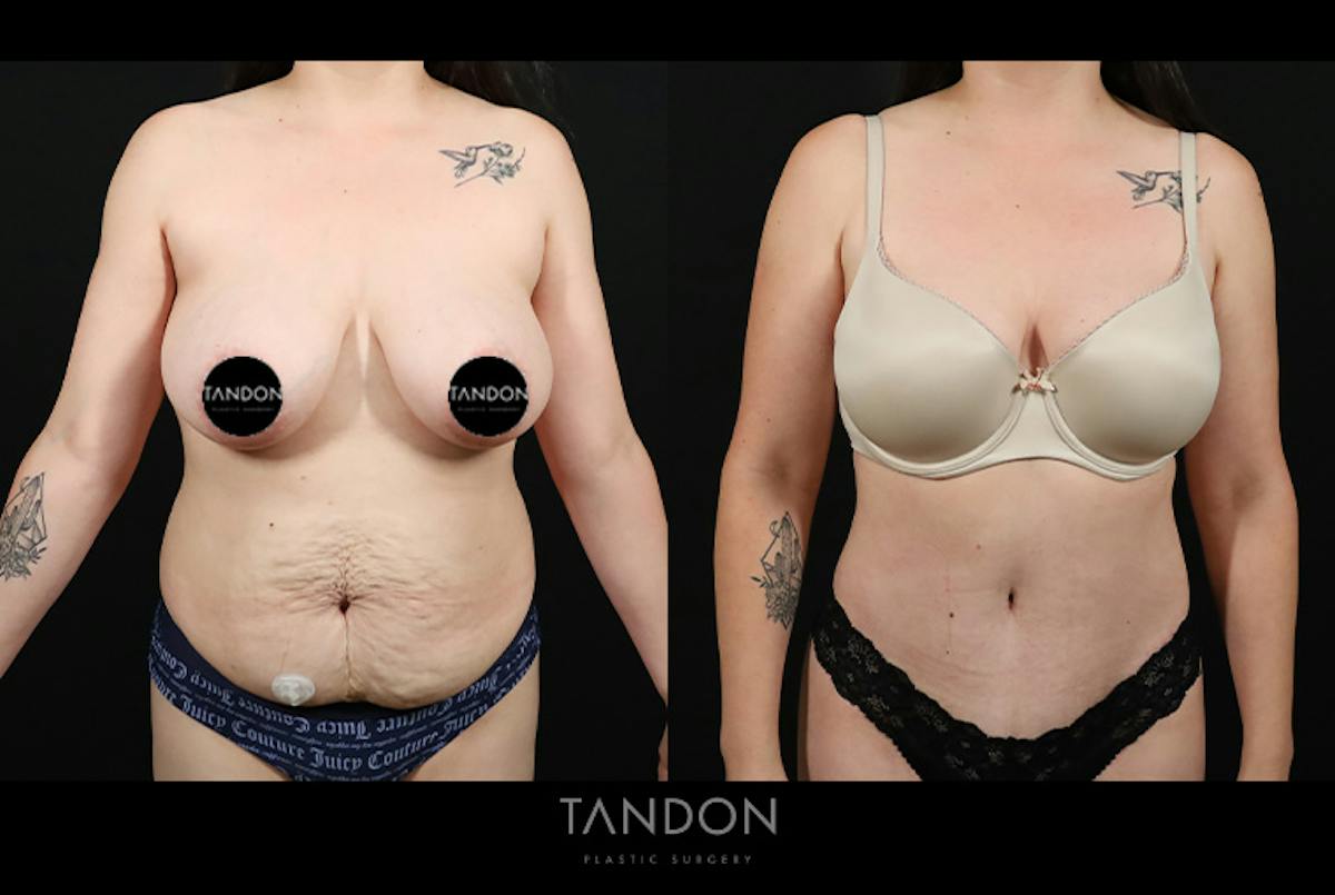 Abdominoplasty (Tummy Tuck) Before & After Gallery - Patient 116559 - Image 1