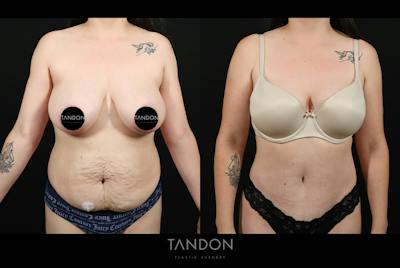 Liposuction and Fat Transfer Before & After Gallery - Patient 260082 - Image 1