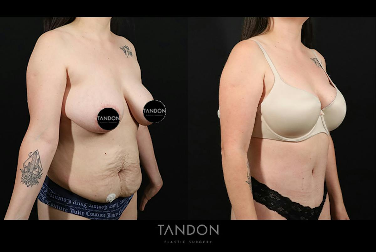 Abdominoplasty (Tummy Tuck) Before & After Gallery - Patient 116559 - Image 3