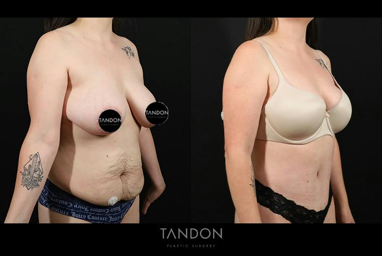 Abdominoplasty (Tummy Tuck) Before & After Gallery - Patient 116559 - Image 3