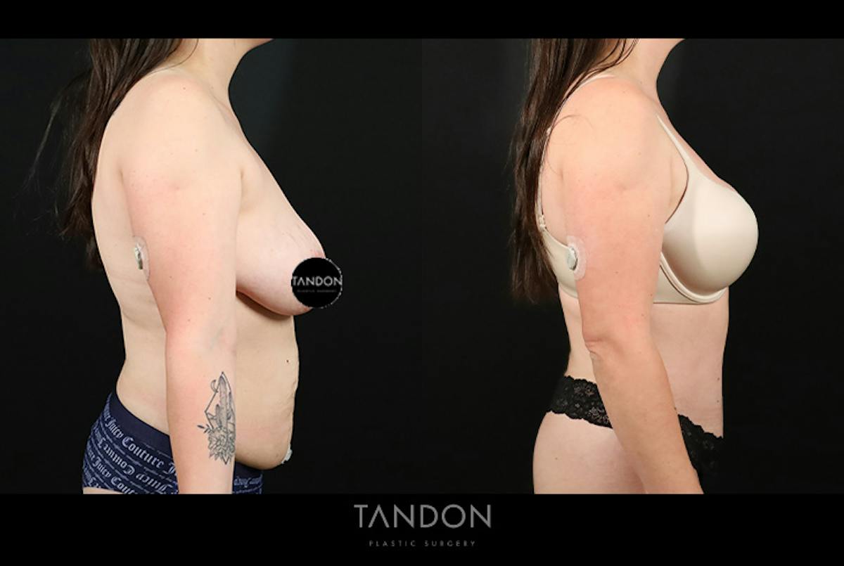 Abdominoplasty (Tummy Tuck) Before & After Gallery - Patient 116559 - Image 6