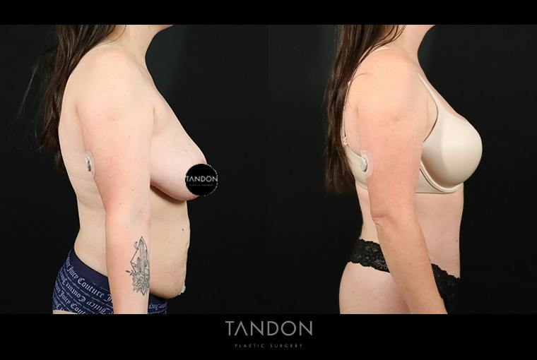 Abdominoplasty (Tummy Tuck) Before & After Gallery - Patient 116559 - Image 6