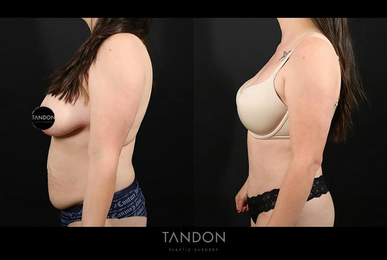 Abdominoplasty (Tummy Tuck) Before & After Gallery - Patient 116559 - Image 4