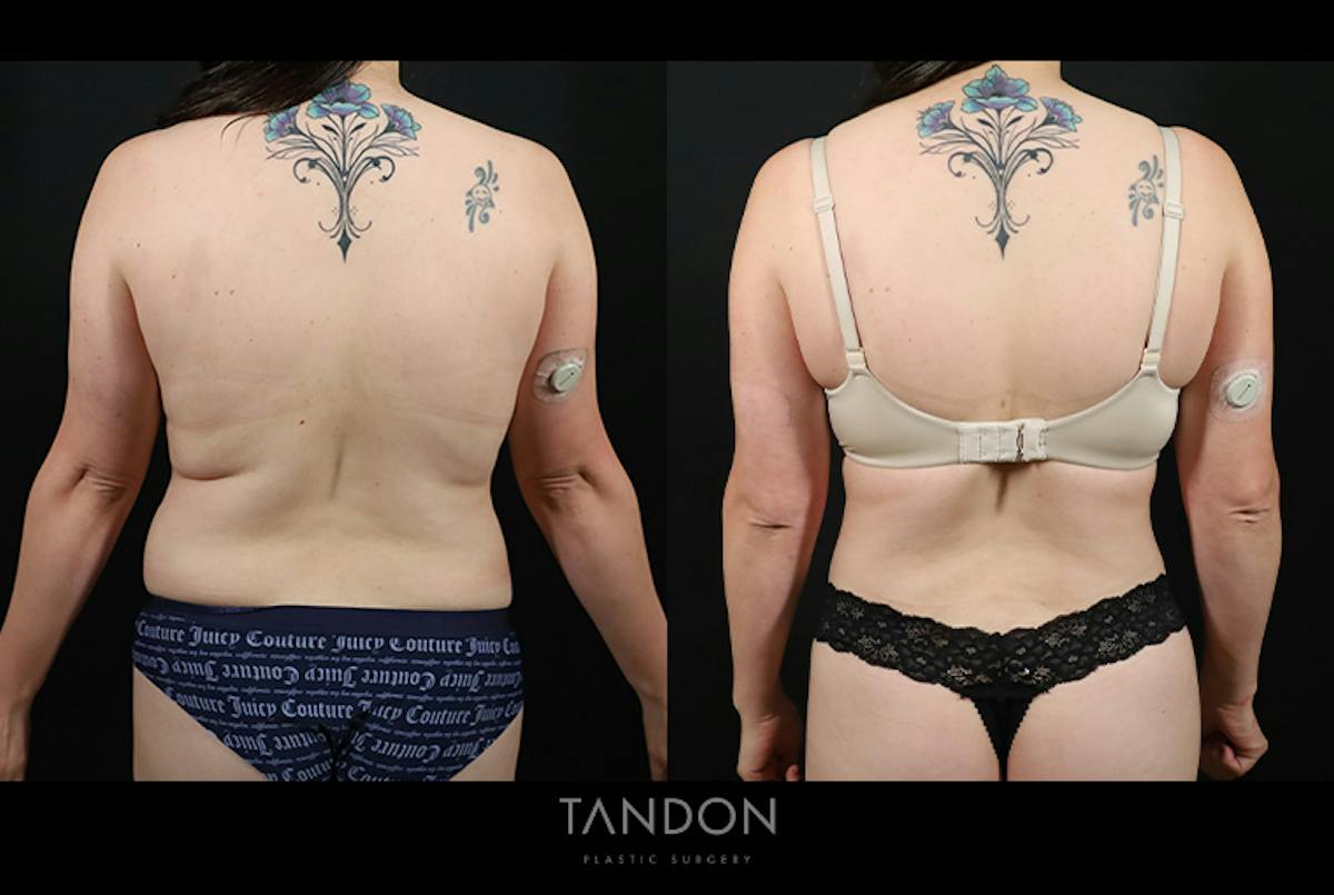 Abdominoplasty (Tummy Tuck) Before & After Gallery - Patient 116559 - Image 2