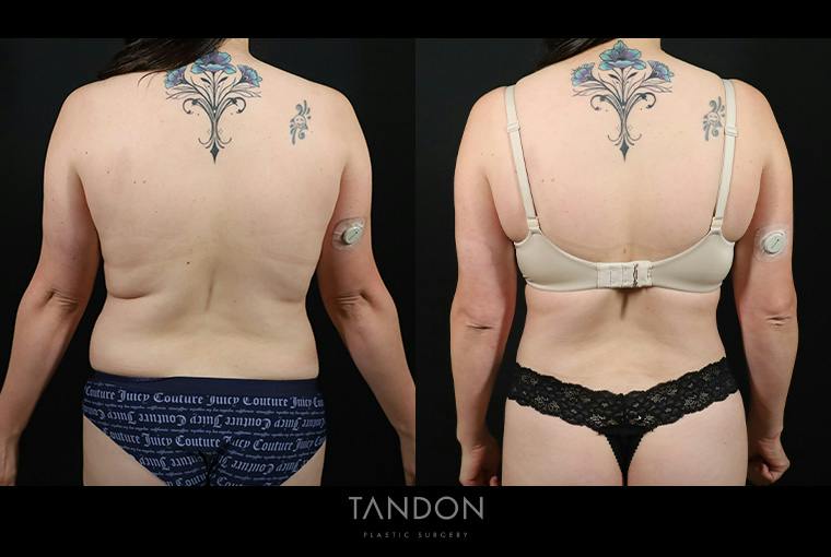 Abdominoplasty (Tummy Tuck) Before & After Gallery - Patient 116559 - Image 2