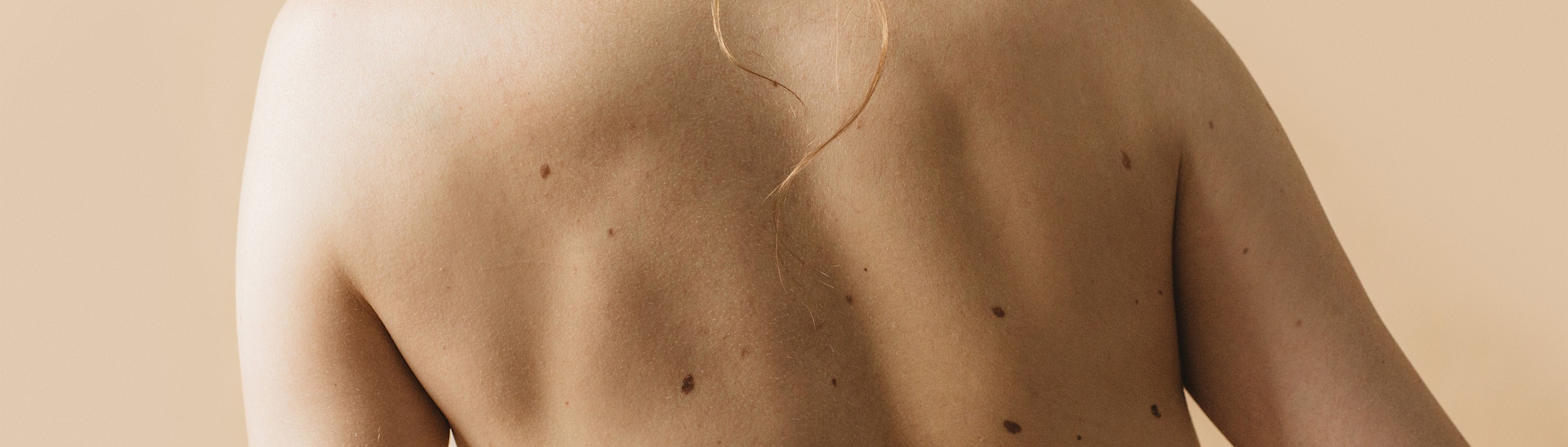 freckles on back
