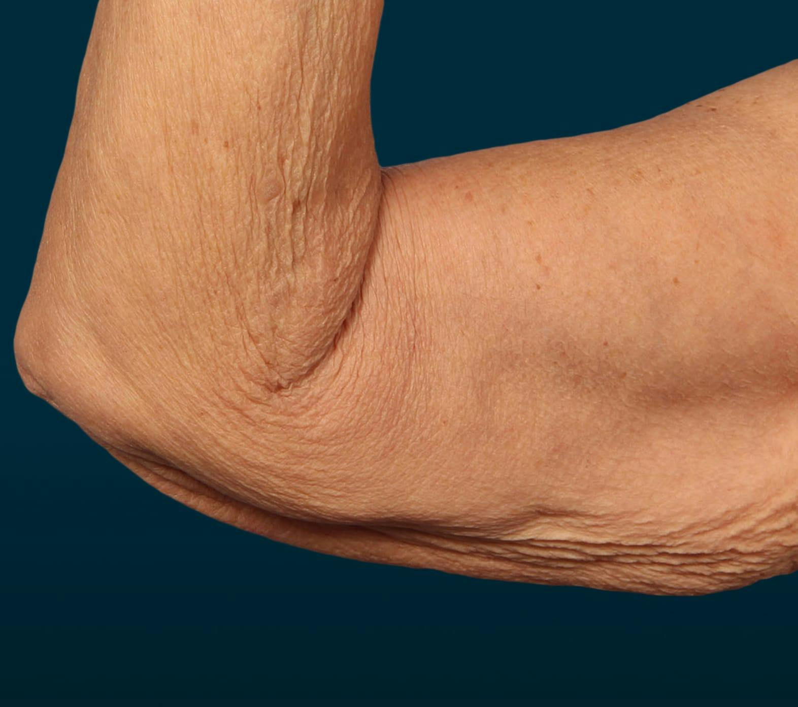Arm lift patient before media