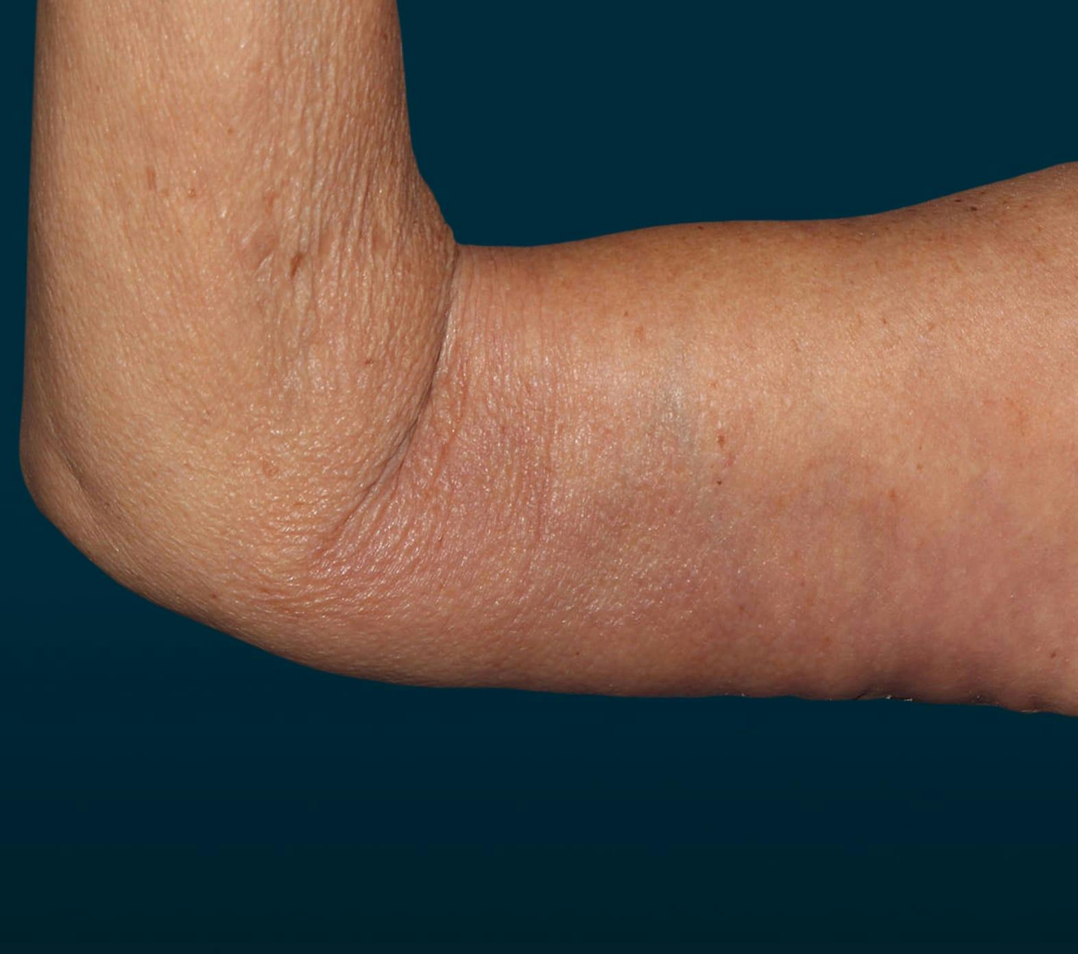 Arm lift patient after media