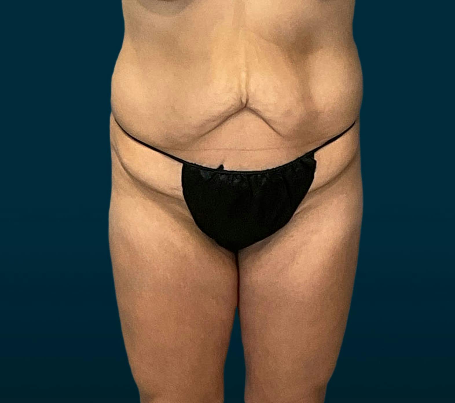 Tummy tuck patient before media
