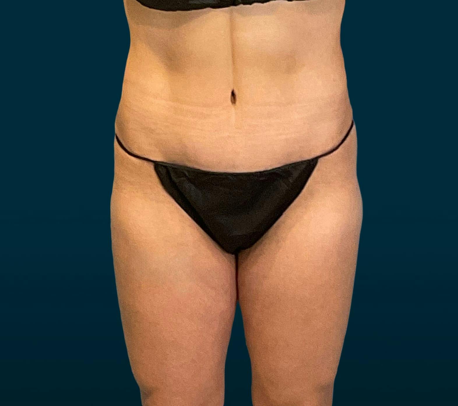 Tummy tuck patient before media