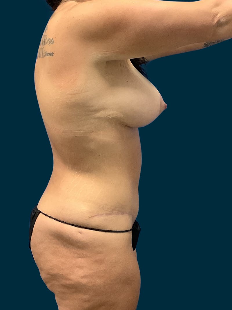Abdominoplasty Before & After Gallery - Patient 145802 - Image 4