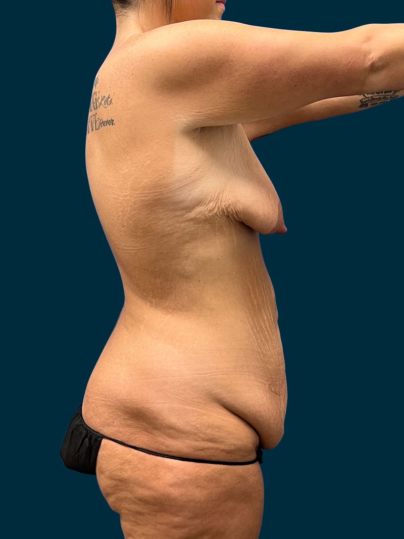 Abdominoplasty Before & After Gallery - Patient 145802 - Image 3